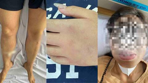 8 người ở Lạng Sơn nhập viện vì ong đốt khi đi tảo mộ