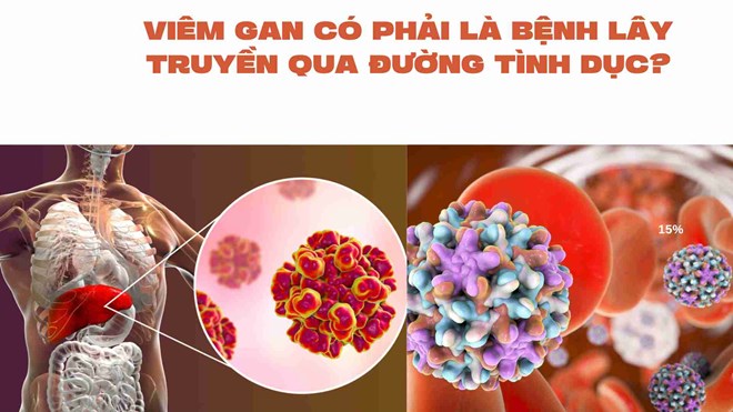 Viêm gan có phải là bệnh lây truyền qua đường tình dục?