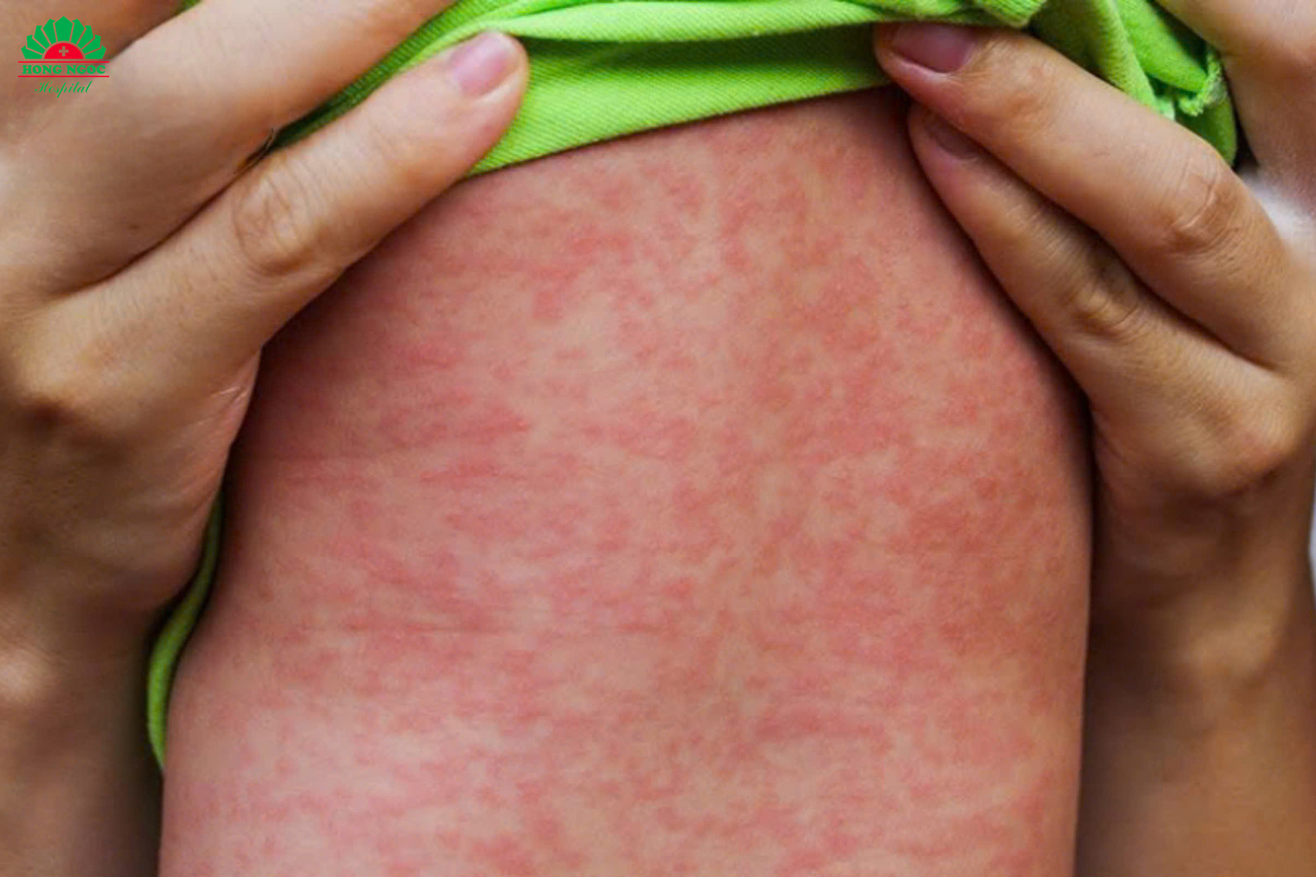 soi vao chu ky bung phat 5 nam 1 lan canh bao nhieu tre bien chung nang hinh 1