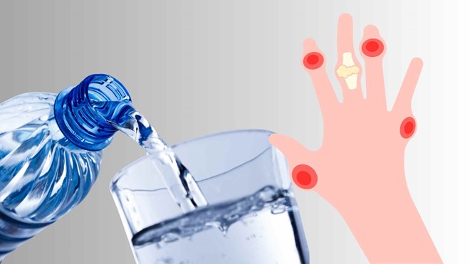 2 cách đơn giản giúp ngăn ngừa bệnh gút