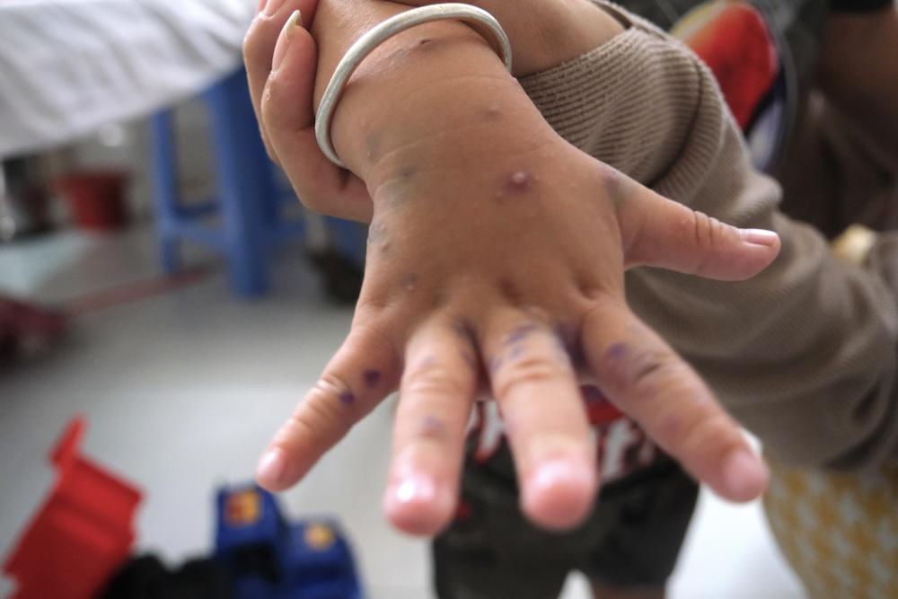 Bệnh tay chân miệng tại ĐBSCL đang diễn biến phức tạp, bác sĩ cảnh báo trẻ hoàn toàn có thể bị nhiều lần. Ảnh: Phong Linh.