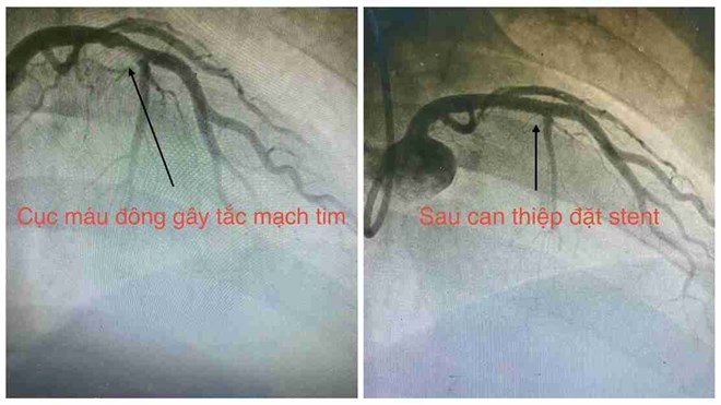 Cứu sống người đàn ông 32 tuổi bị nhồi máu cơ tim cấp khi đang đá bóng
