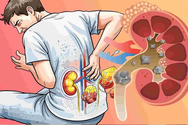 Nam giới có nguy cơ bị sỏi thận cao hơn phụ nữ