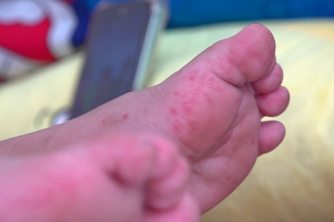 Dịch bệnh tay chân miệng xuất hiện tại tất cả các xã, phường của Hà Nội