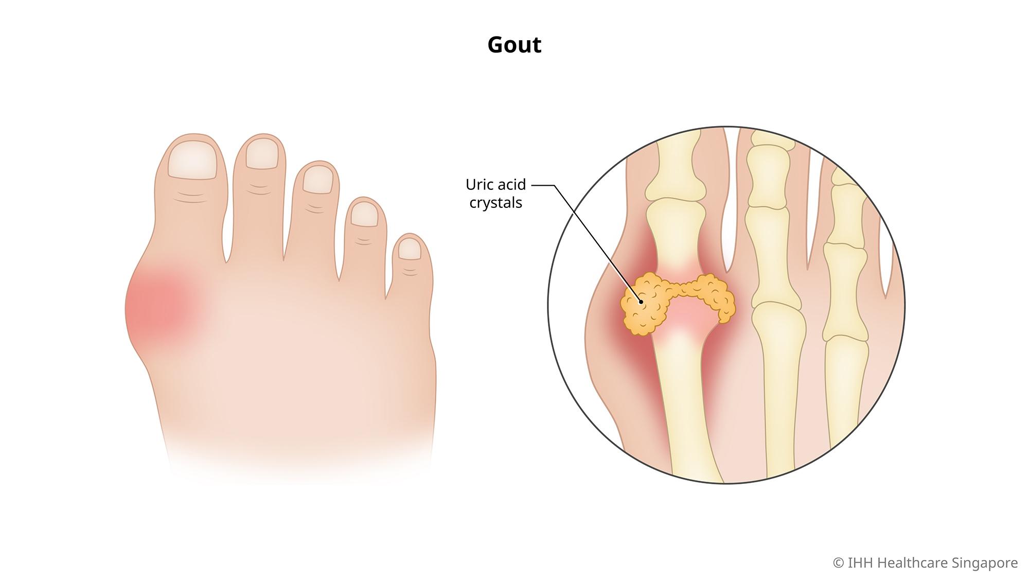Thực phẩm giàu purin làm tăng axit uric máu dẫn đến sỏi thận và bệnh gút.
