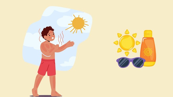 4 cách giúp phòng tránh cháy nắng hiệu quả trong mùa hè