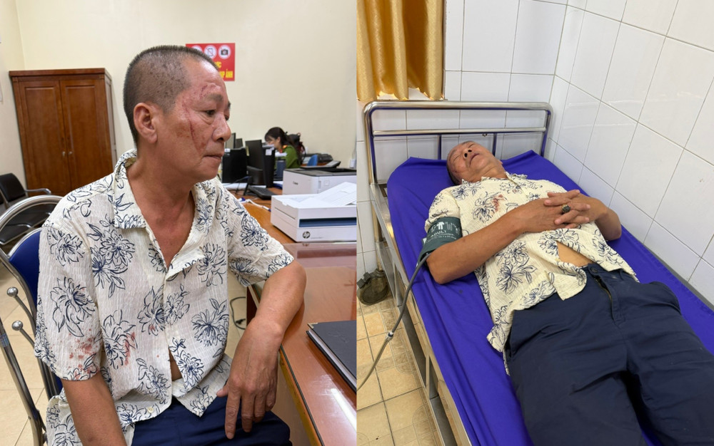 Ông Thu phải nhập viện sau khi bị hành hung - Ảnh: Nạn nhân cung cấp. 1000053197.jpg